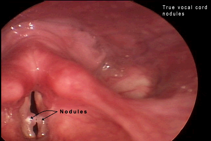 Throat Nodule 49