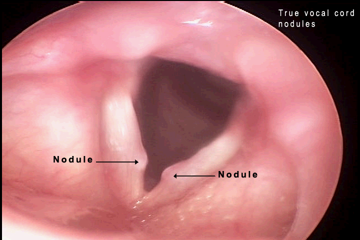 vocal nodules and singers