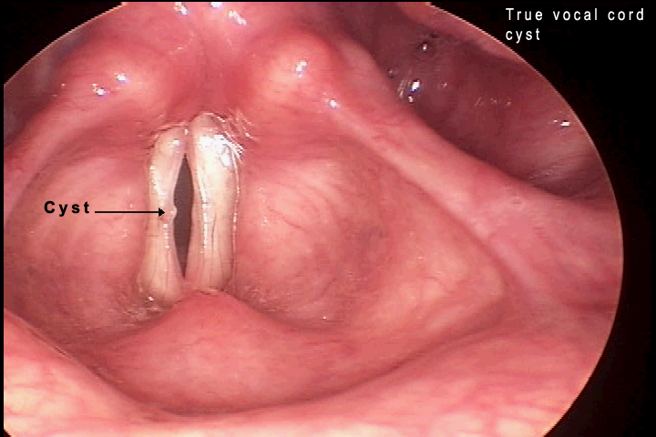 vocal nodules and singers