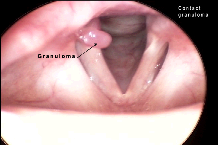 laryngeal papilloma lesion