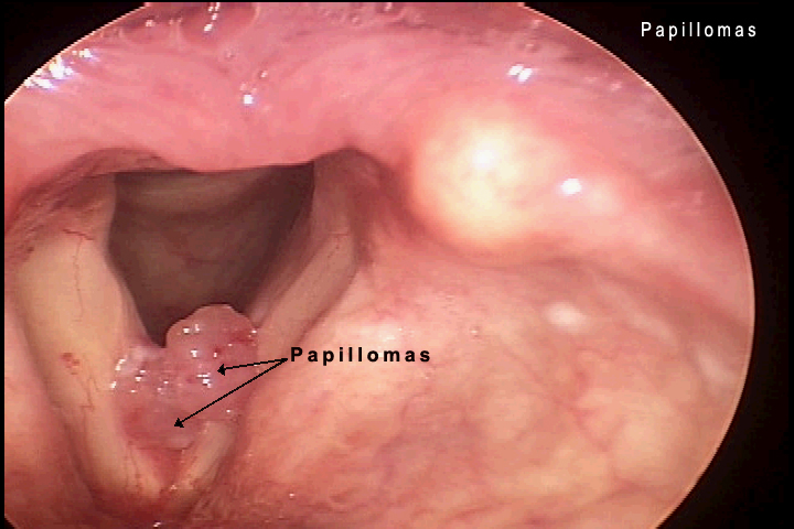 laryngeal papillomas lesions