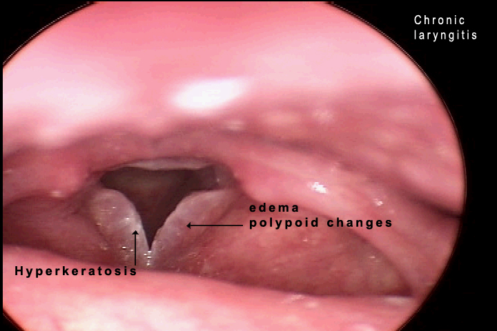 Benign Laryngeal Lesions