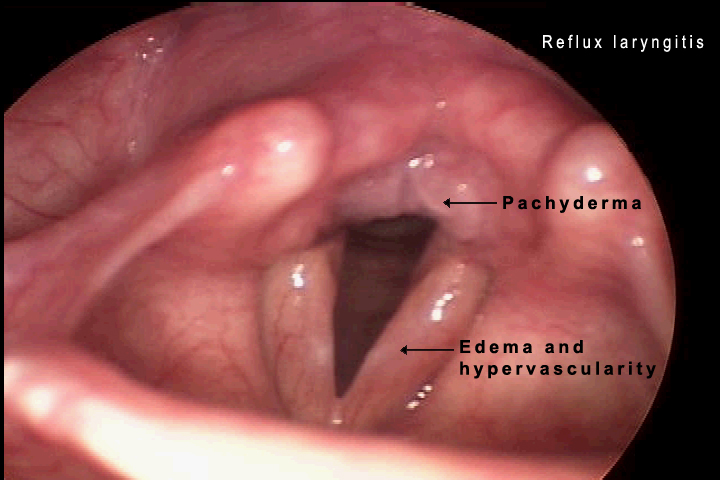 Benign Laryngeal Lesions