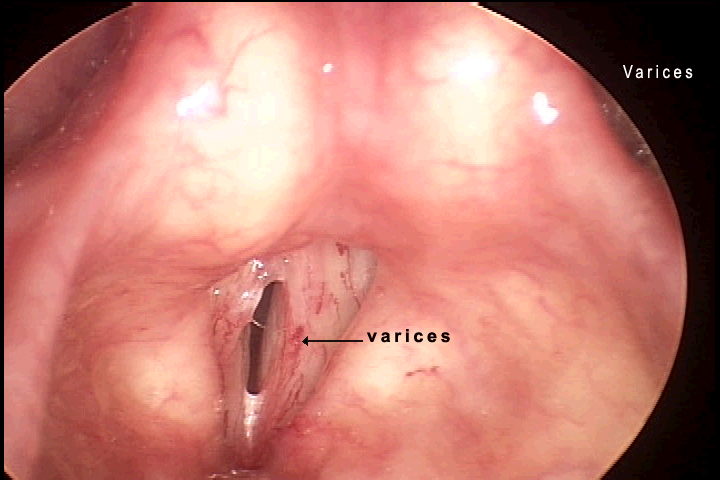 vocal cords damaged