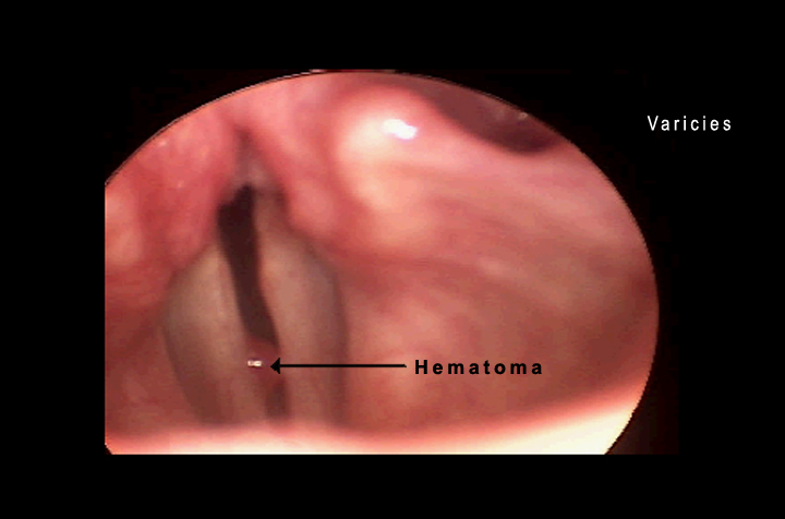 Traumatic Laryngeal Lesions