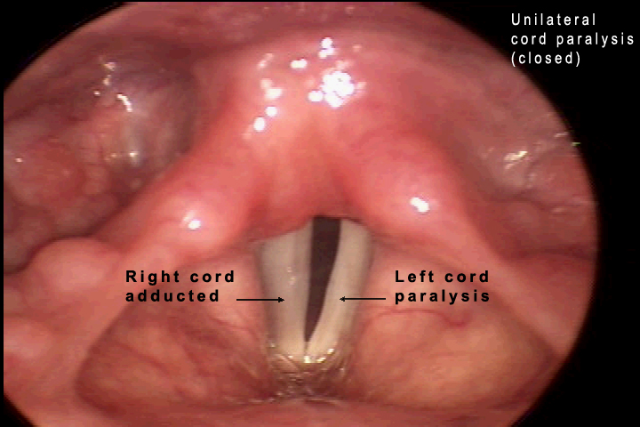 vocal cord paramedian