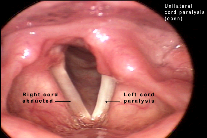 bilateral vocal cord paralysis