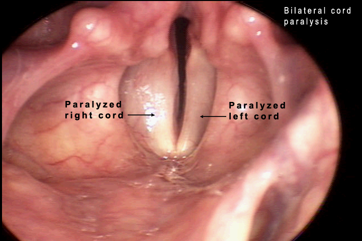 vocal cord paramedian