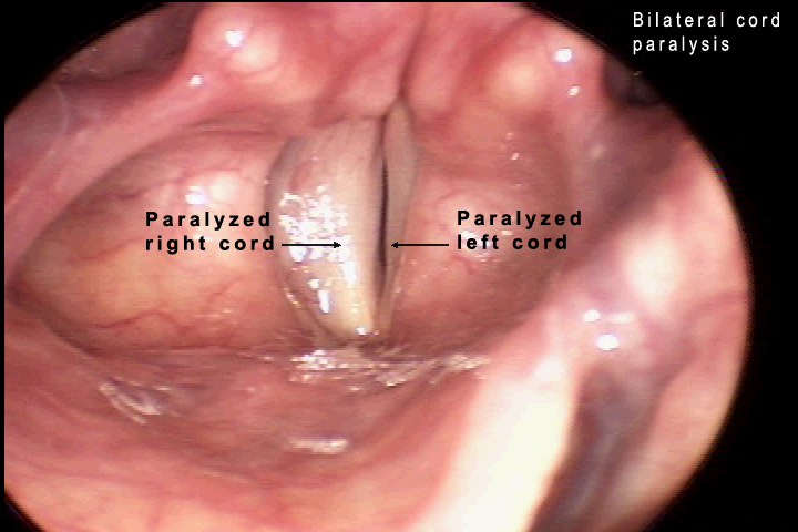 bilateral vocal cord paralysis