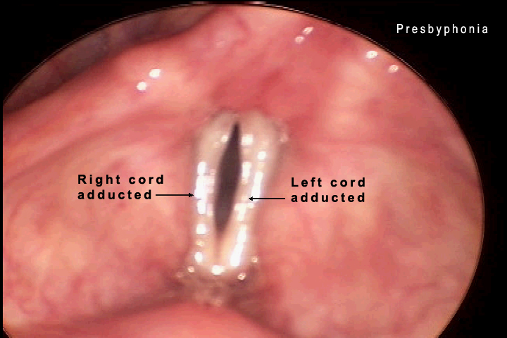 vocal cord paramedian