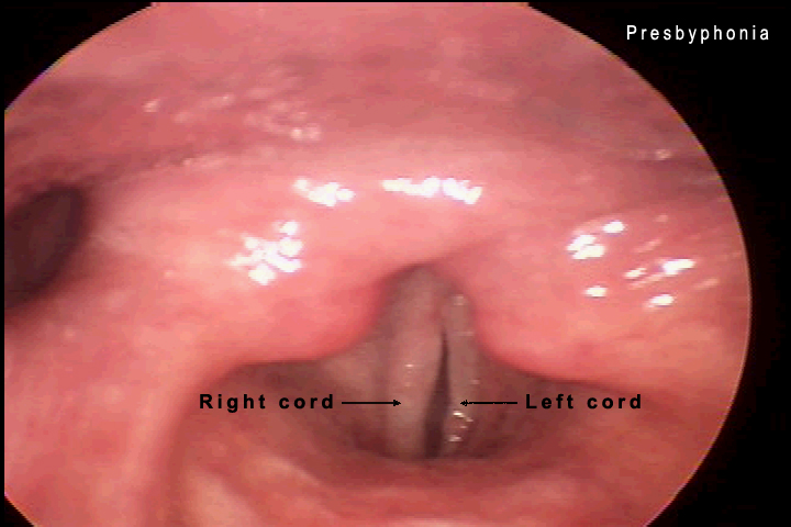 vocal cord paramedian