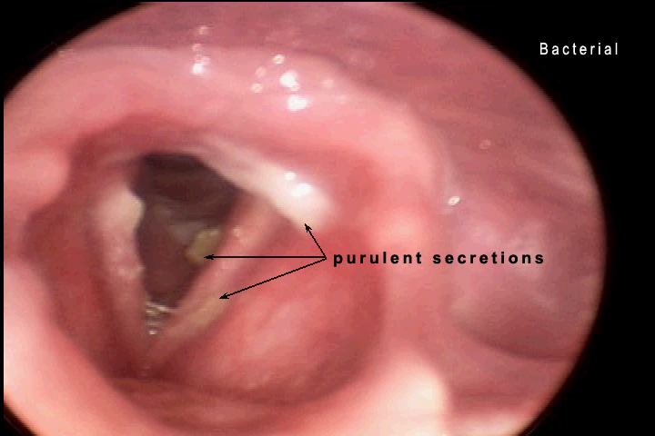 acute laryngitis