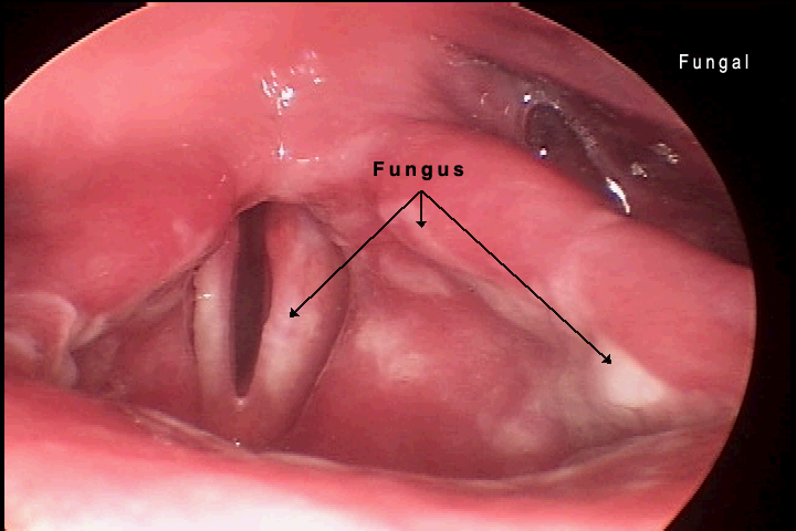 yeast infection in throat