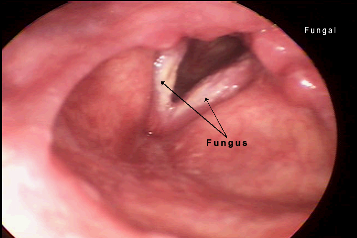 acute laryngitis