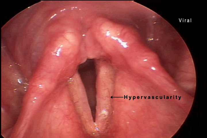 acute laryngitis