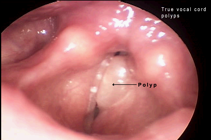 vocal nodules and singers