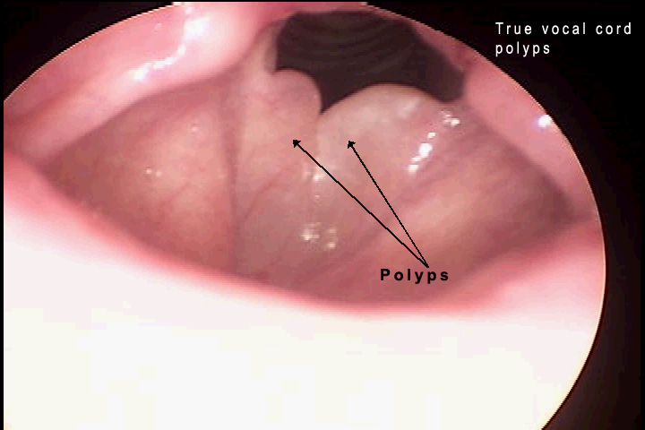 vocal nodules and singers